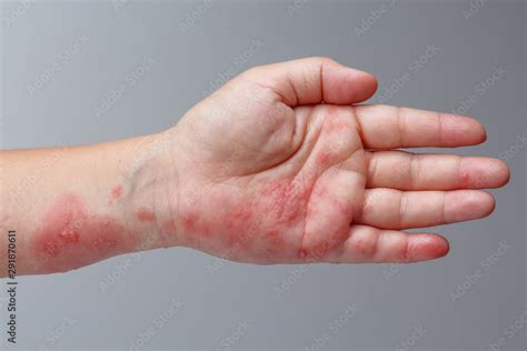 Shingles, Zoster or Herpes Zoster symptoms on arm Stock Photo | Adobe Stock