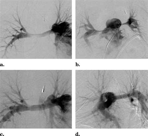 a) Angiogram of right pulmonary artery before stent placement. (b)... | Download Scientific Diagram