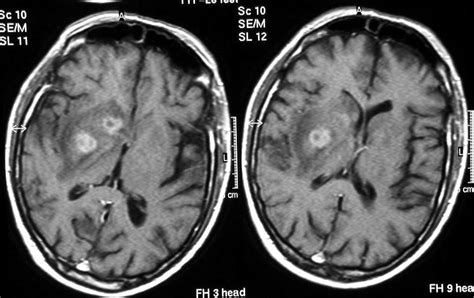 Imaging in CNS Toxoplasmosis | Radiology, Radiography, Neurology