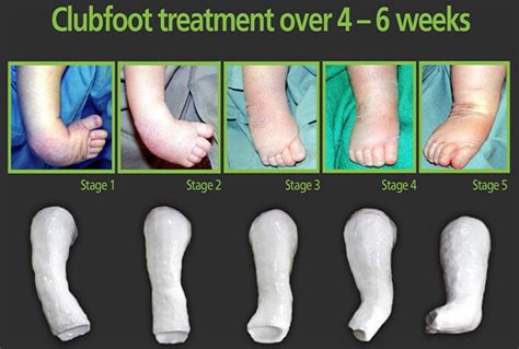 Club Foot - Congenital Clubfoot Causes, Types, Symptoms & Treatment