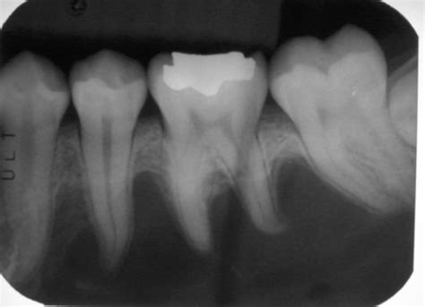 Simple Bone Cyst – Dr. G's Toothpix