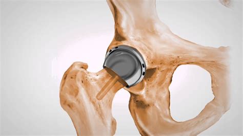 Stryker Recalls 2 Hip Implants | weather