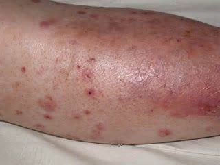 What Causes Blisters On Legs In Diabetics - DiabetesWalls