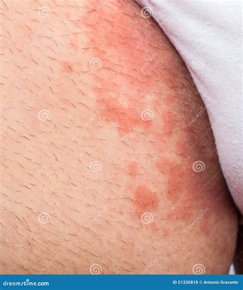 Eczema groin stock photo. Image of atopic, medicine, hives - 51330818