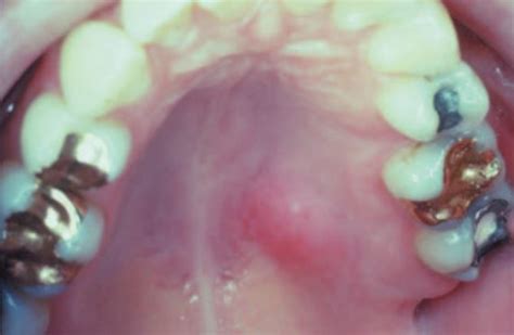 Necrotizing Sialometaplasia - Dr. Paul Mirdamadi DDS