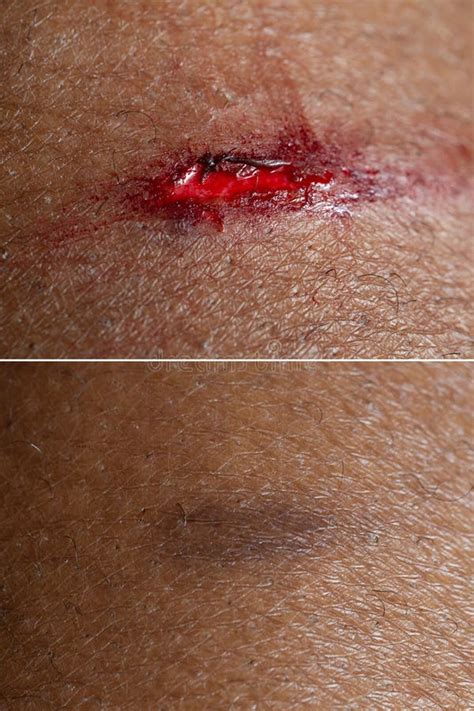 Superficial Wound before and after a Connective Tissue Treatment Stock ...