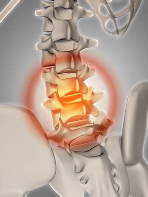 What are Tarlov Cysts and How are They Treated? - iinn