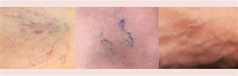 Spider and Reticular Veins - iBeauty Cosmetic Clinic Gold Coast