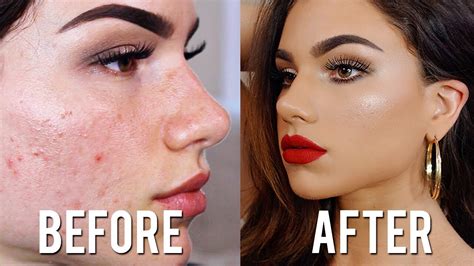 Best Makeup To Cover Acne Pits | Makeupview.co