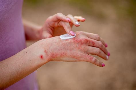 How Hand Eczema Is Treated