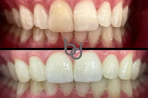 Types Of Wisdom Tooth Extractions - Arcadia ICO