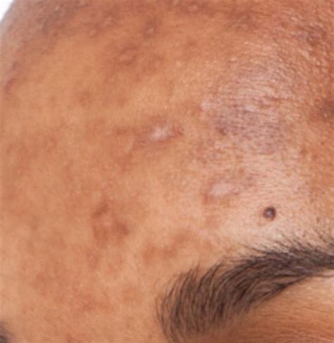 Melasma: Causes, Treatment Options, and Management