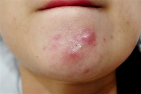 How to Prevent Cystic Acne [AND] Get Rid of Cystic Acne! NATURALLY...