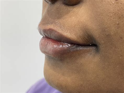 Lip Pigmentation Treatment in Chennai - Armoraa Clinic