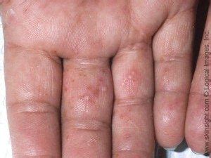 Infected Dyshidrotic Eczema Popping Images