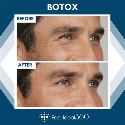 Botox Before And After Man Wrinkles - Feel Ideal 360 Med Spa - Southlake, TX