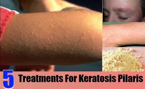 5 Effective Treatments For Keratosis Pilaris – Natural Home Remedies & Supplements