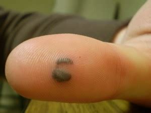 👉 Blood Blister on Finger - Causes, Treatment, Healing time, Pictures (January 2022)