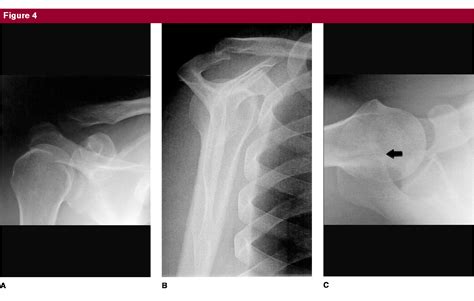 Figure 1 from Symptomatic os acromiale. - Semantic Scholar