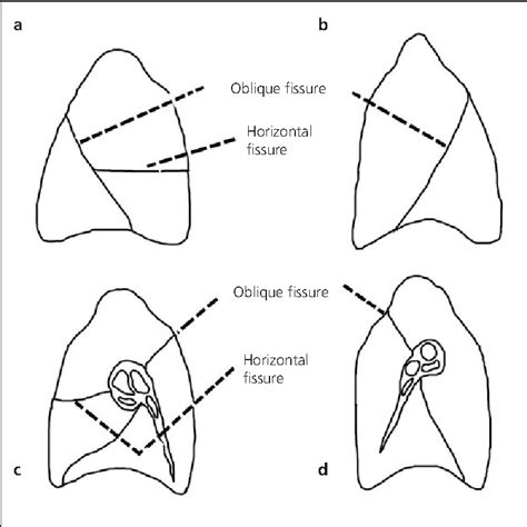 Figure 1 from Lung lobes and fissures: a morphological study | Semantic Scholar