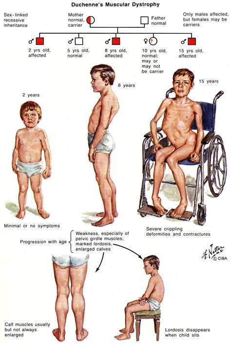 Duchenne Muscular Dystrophy Treatment