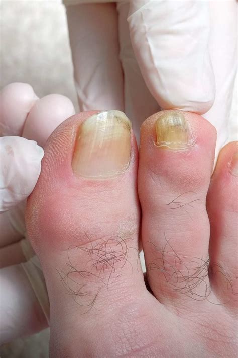 Why are my toenails yellow: Causes and treatment