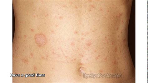 Fungal Skin Rash On Arms