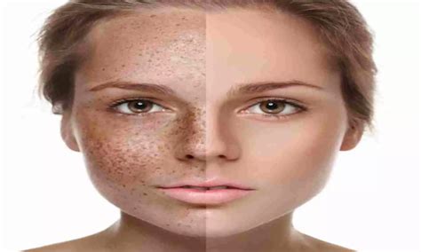 Sunspots on face Causes treatments sunspots harmless and How to Remove Sunspots side effects in ...