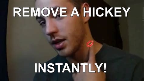 How To Get Rid of or Remove a Hickey! - YouTube