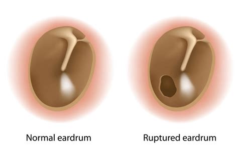 Tympanic Membrane Perforation – Ruptured Eardrum