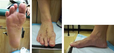 Use of a Second Ray Amputation for Foot Salvage in a Collegiate Athlete with Proteus Syndrome