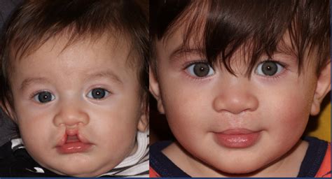 Bilateral Cleft Lip And Palate Before And After