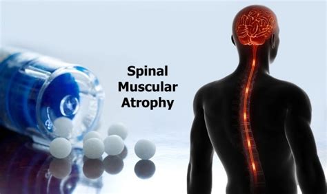 Spinal Muscular Atrophy – Types, Diagnosis, and Treatment.