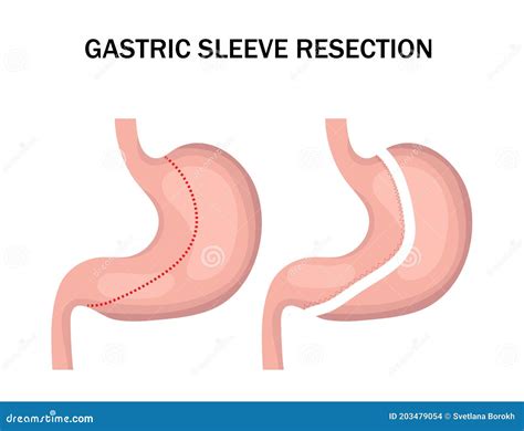 Gastric Sleeve Resection Infographic. Stomach Reduction Surgery for Weight Loss. Medicine ...