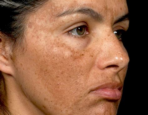 Melasma - Lowe Dermatology Laser Procedure Correction