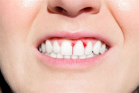 Do You Have Periodontal Disease? Here Are a Few Signs to Look For…