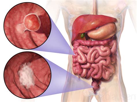 Colon Cancer (Colorectal Cancer) — Causes, Symptoms and Prognosis