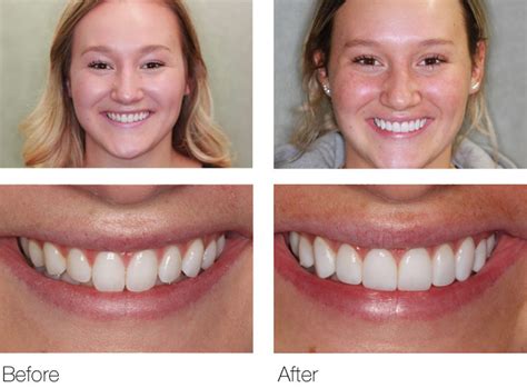 Composite Veneers in San Ramon | Cosmetic Composite Dental Veneers