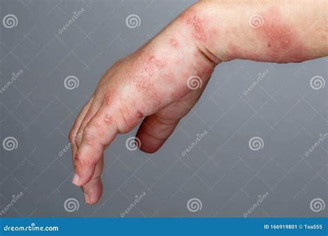 Shingles Symptoms - Viral Infection That Causes A Painful Rash, Medical Text Concept On Card ...