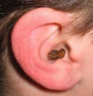 Earwax? in 2023 | Ear wax removal, Ear wax, Ear wax buildup