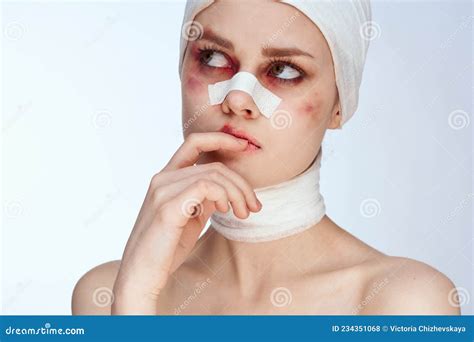 Portrait of a Woman Bruised Face Medicine Treatment Injury Accident ...