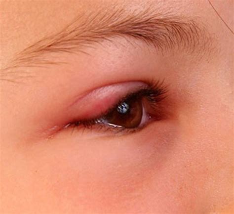 Swollen Eyelid - Symptoms, Treatment, Pictures, Causes | HealDove