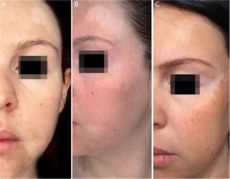 Partial repigmentation of vitiligo with tofacitinib, without exposure to ultraviolet radiation ...