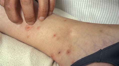 How To Treat A Bed Bug Rash - PestPhobia