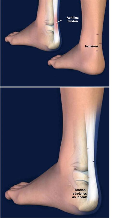 Achilles Tendon Lengthening (Surgery) Pediatric Foot Ankle | peacecommission.kdsg.gov.ng
