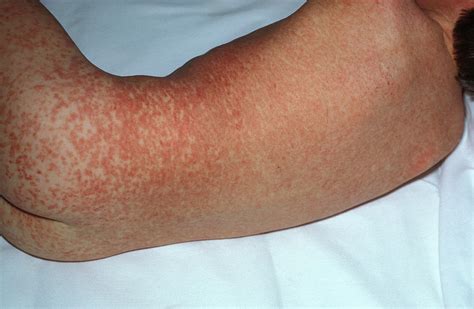 Measles Rash