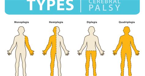 stimr.com: Hemiplegia & the OT role