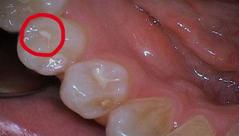 Hidden Cavities: Detection and Treatment