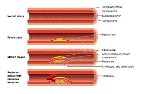 Arteria con colesterol stock de ilustración. Ilustración de arterial ...