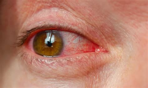 Read Insights about Red Bloodshot Eyes: A Cause For Concern? from Auckland Eye